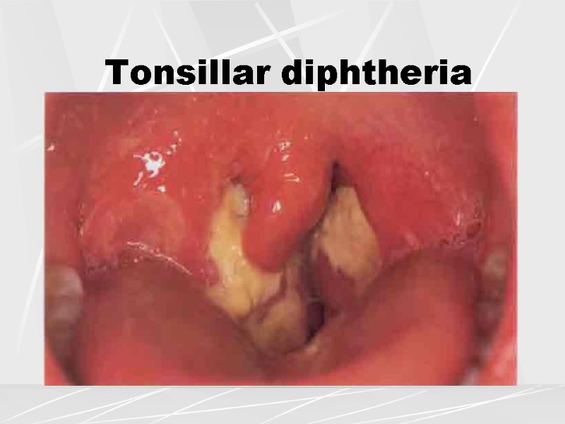 Tonsillar diphtheria